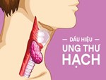 Loại ung thư diễn viên trong Đội đặc nhiệm nhà C21 mắc phải - Nhiều người chủ quan với dấu hiệu dễ thấy nhất-2