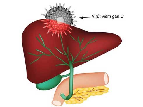 Mắc căn bệnh lây nhiễm này, người bệnh có nguy cơ ung thư cao gấp 12 lần bình thường