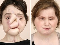 Cô gái 'được sống lại lần nữa' sau cuộc đại phẫu cấy ghép mặt dài 31 tiếng Cô gái 'được sống lại lần nữa' sau cuộc đại phẫu cấy ghép mặt dài 31 tiếng