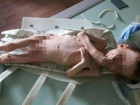 Cậu bé 4 tuổi chỉ còn da bọc xương vì bị bố mẹ bỏ đói gần chết