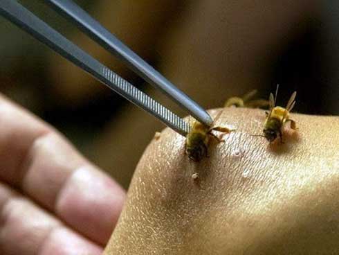 Bạn đang tìm hiểu về nguyên nhân tử vong do ong vò vẽ? Hãy xem hình ảnh này để có cái nhìn rõ ràng hơn về vấn đề này. Đây là một hình ảnh chân thực và đầy cảm hứng mà bạn không thể bỏ qua.