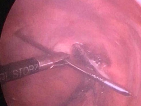 Đinh nhọn 12cm đâm qua đỉnh phổi, xuyên thẳng vào tủy sống bệnh nhân