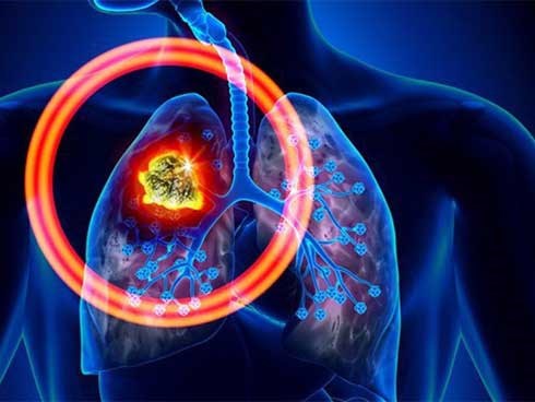 Xu hướng người trẻ tuổi mắc ung thư phổi đang tăng nhanh: Làm sao để phát hiện sớm nhất?