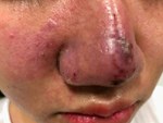 Tiêm filler nâng mũi, nữ sinh viên 20 tuổi ở Sài Gòn đối diện nguy cơ hoại tử da, mù mắt vĩnh viễn-6