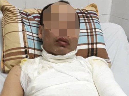 Con gái ngồi trong xe ô tô sợ hãi chứng kiến cảnh bố bị tạt axit khắp cơ thể
