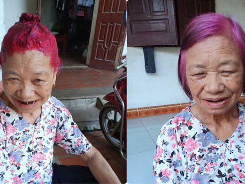 Cô gái bị biến dạng khuôn mặt sau một đêm, nguyên nhân không ngờ là thứ mà đa số chị em đều dùng-3