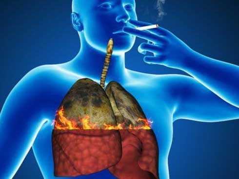 Những dấu hiệu sớm của bệnh ung thư phổi ở nam giới