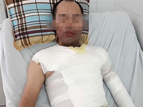 Vụ người đàn ông bị tạt axit ở Hà Đông: Con gái hoảng loạn vì chứng kiến bố bị tấn công