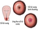 Dùng giấy vệ sinh sai cách, cô gái 20 tuổi bị ung thư cổ tử cung-4