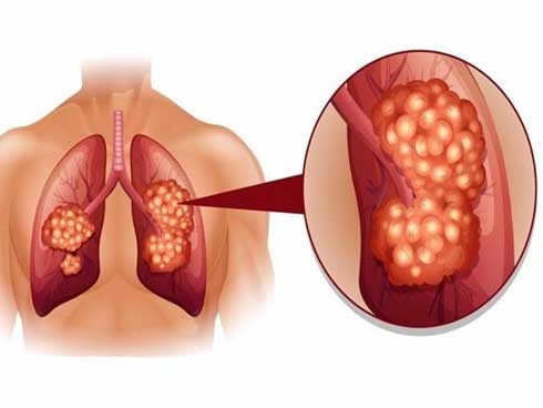 Lý do nguy hiểm khiến đa số bệnh nhân ung thư phổi đều phát hiện bệnh ở giai đoạn muộn