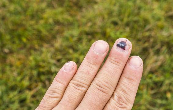 Móng tay bầm tím không rõ nguyên nhân, bác sĩ mãi không thể lý giải cho đến khi xét nghiệm-3