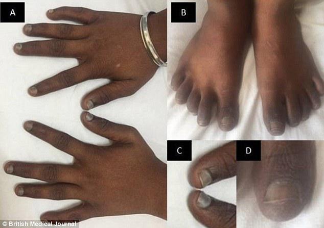 Móng tay bầm tím không rõ nguyên nhân, bác sĩ mãi không thể lý giải cho đến khi xét nghiệm-1