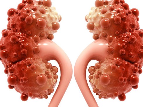 8 dấu hiệu quan trọng nhất cảnh báo thận bị nhiễm độc nặng: Cần phát hiện và đi khám sớm