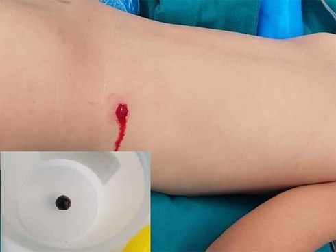 Nghịch súng, bé trai 5 tuổi bị đạn bắn xuyên hông