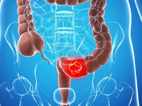 Các nhà nghiên cứu khẳng định: Làm tốt 2 việc này có thể ngăn ngừa ung thư đại trực tràng