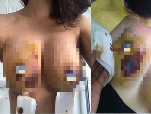 Phẫu thuật ngực như hot girl ngực khủng ở Hải Dương, bạn phải đối mặt với nguy cơ nào?