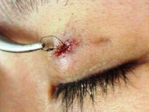 Nhấn mí để mắt long lanh hơn, nữ thanh niên bị u hạt nhiễm khuẩn, chỉ thò ra ngoài