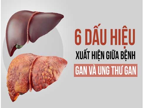 6 dấu hiệu cảnh báo khi bệnh gan tiến triển thành ung thư: Phát hiện sớm là rất quan trọng