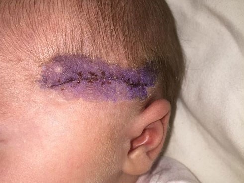 Bác sĩ rạch trúng đầu em bé trong ca sinh mổ, không xin lỗi còn nói rằng