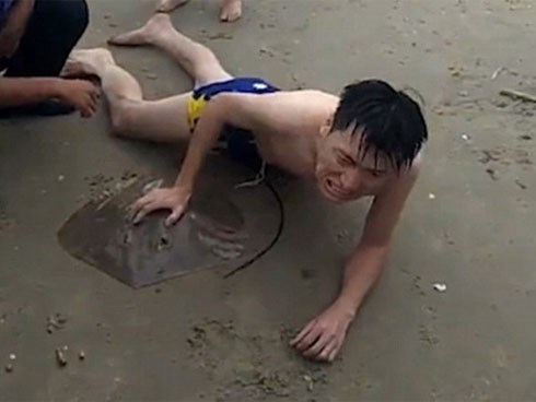 Bị cá đuối gai độc cắm vào 'của quý' khi đi tắm biển