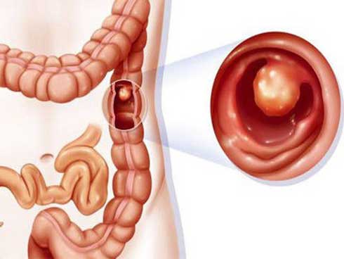 Một gia đình có tới 9 người bị ung thư-2