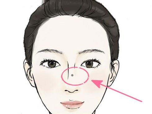 Nốt ruồi ở 3 vị trí 