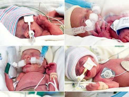 Hy hữu ca sinh mổ với đội ngũ y bác sĩ lên tới 35 người để giúp… 6 em bé chào đời