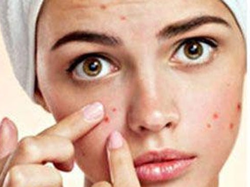 Học ngay 8 cách trị mụn trứng cá đơn giản mà hiệu quả không ngờ