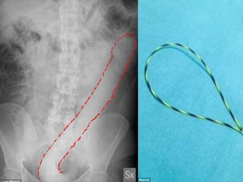 Thử cảm giác lạ bằng dương vật giả 60cm, người đàn ông khóc thét vì không thể rút ra