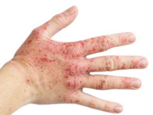 Vết bầm tím trên da cảnh báo loạt bệnh nguy hiểm, đọc ngay để phòng kịp thời