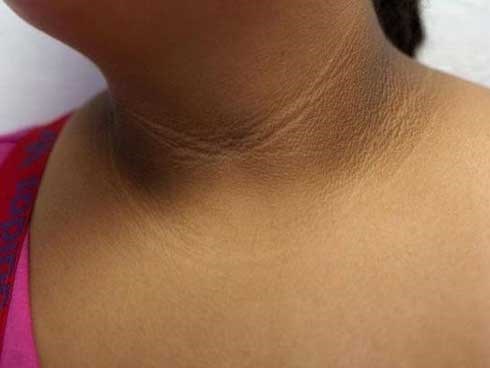 Bé 10 tuổi có vệt đen trên cổ, bác sĩ nói tuy nhẹ nhưng cảnh báo bệnh nguy hiểm hơn