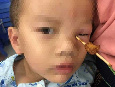 Que tăm xuyên vào hốc mắt bé 4 tuổi