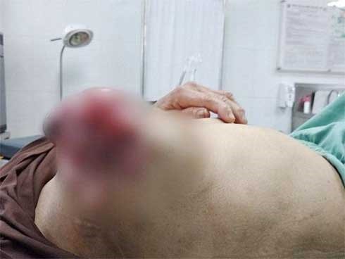 Đắp lá chữa ung thư vú, người phụ nữ phải nhập viện vì bị lở loét, chảy dịch