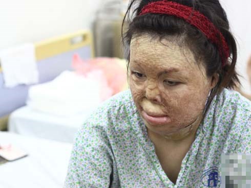 Người vợ Hà Nội bị chồng thiêu hôm mùng 2 Tết, chỉ có 1% cơ hội sống sót đã 