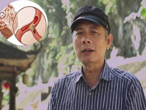 Căn bệnh khiến đạo diễn Đông Hồng tử vong ngày càng gặp nhiều ở người trẻ