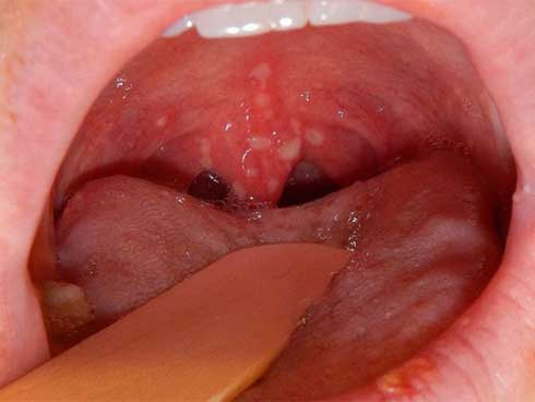 Có dấu hiệu chết người này không khỏi sau 2 - 3 tuần, hãy cẩn trọng với ung thư cổ họng-1