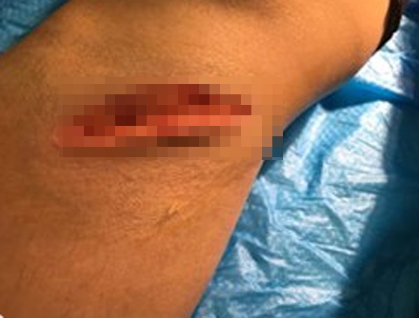 Vì ghen tuông, nữ hộ lý bị chồng dụ lên đồi đánh đập dã man, cắt gân chân-2