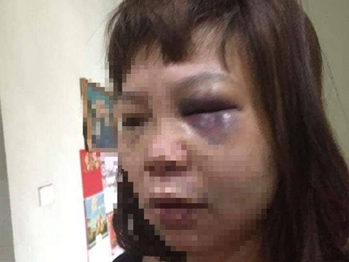 Tin mới nhất vụ nữ hộ lý bị chồng đưa lên đồi bạo hành, dùng dao cắt gân chân-2