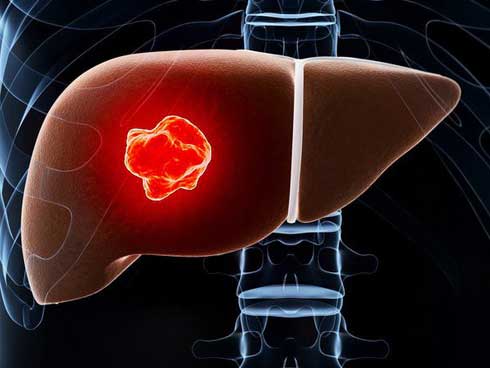 5 yếu tố lớn nhất có nhiều khả năng gây ung thư gan: Dù bạn ở lứa tuổi nào cũng nên tránh-1