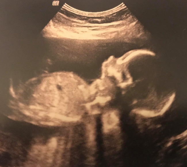 Bé sinh non bị đứt lìa người vì sai lầm của bác sĩ trong lúc đỡ đẻ-1