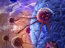 Hiệp hội Ung thư Mỹ chỉ cách phát hiện sớm 6 loại ung thư, trước khi có các dấu hiệu bệnh-1