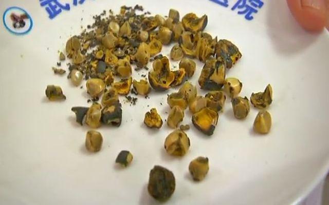 Tưởng không ăn thịt sẽ tốt cho sức khỏe, người phụ nữ phải trả giá đắt-1