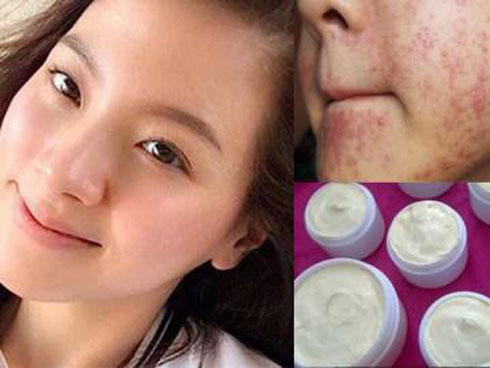 Bôi kem trộn, mặt thiếu nữ sưng vù, chi chít mụn mủ chưa từng thấy-5