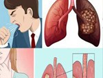 Vì sao số người mắc ung thư phổi ngày càng tăng? Chuyên gia cảnh báo nguyên nhân là thứ chúng ta đang tiếp xúc hàng ngày-3