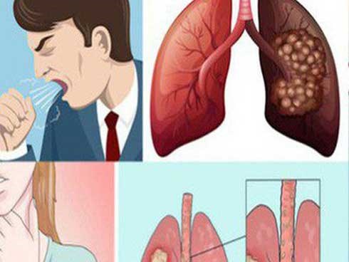Những dấu hiệu tưởng đau lưng nhưng là triệu chứng đầu tiên của ung thư phổi