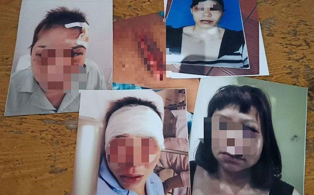 Tâm sự cay đắng của người vợ bị chồng cắt gân chân-1