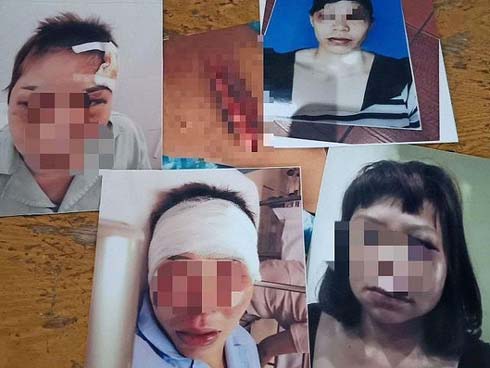 Thông tin mới nhất vụ chồng dùng dao rạch mặt, cắt gân chân vợ hờ ở Bắc Giang-3