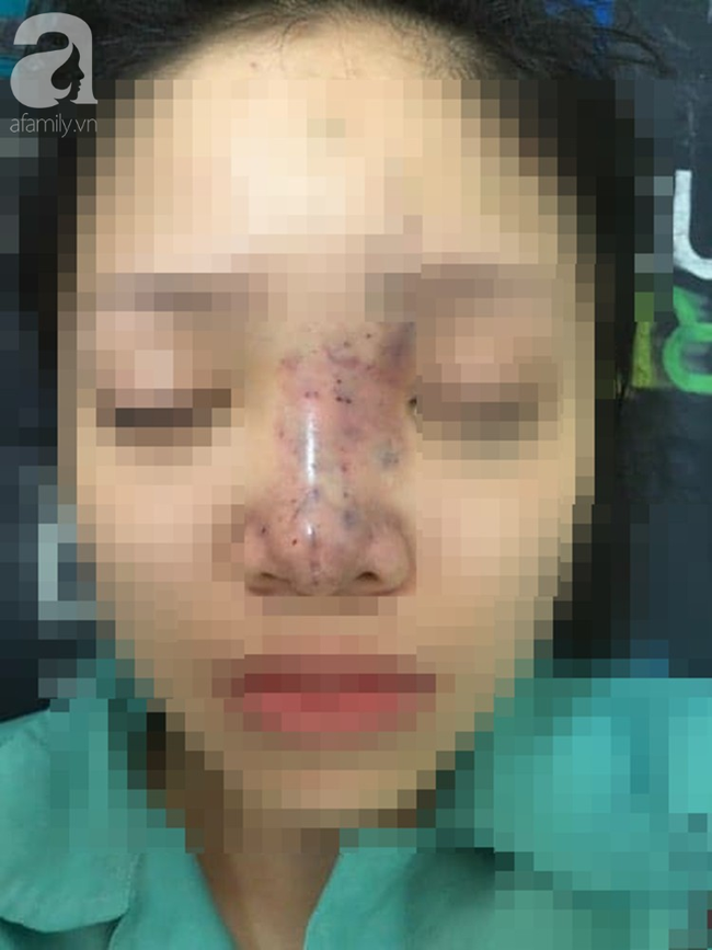 Tiêm filler nâng mũi, nữ sinh viên 20 tuổi ở Sài Gòn đối diện nguy cơ hoại tử da, mù mắt vĩnh viễn-1