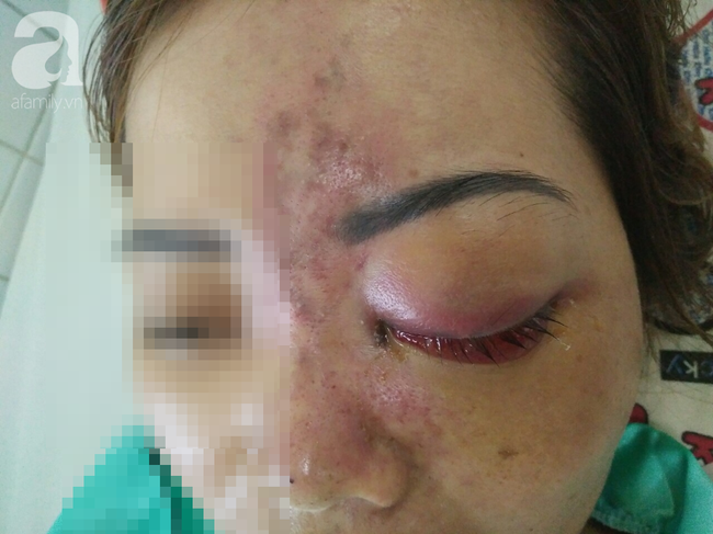 Tiêm filler nâng mũi, nữ sinh viên 20 tuổi ở Sài Gòn đối diện nguy cơ hoại tử da, mù mắt vĩnh viễn-4