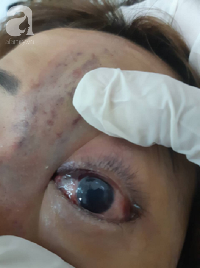 Tiêm filler nâng mũi, nữ sinh viên 20 tuổi ở Sài Gòn đối diện nguy cơ hoại tử da, mù mắt vĩnh viễn-5